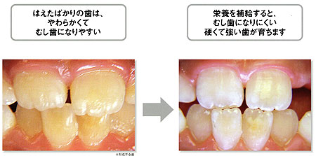 栄養を補給すると、虫歯になりにくい硬くて強い歯が育ちます