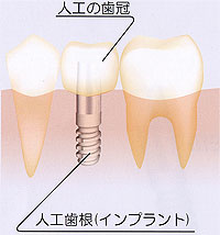 インプラントを入れる