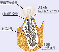 インプラントを入れる
