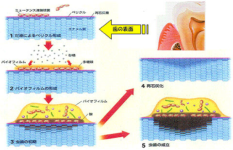 バイオフィルムによる虫歯の成り立ち